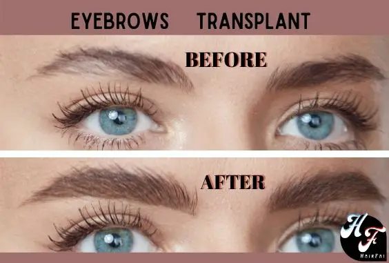 Before and After of Brows Transplant