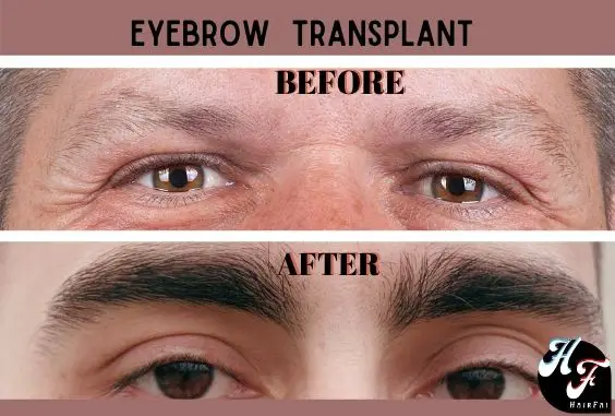 EyeBrow Transplant Before & After